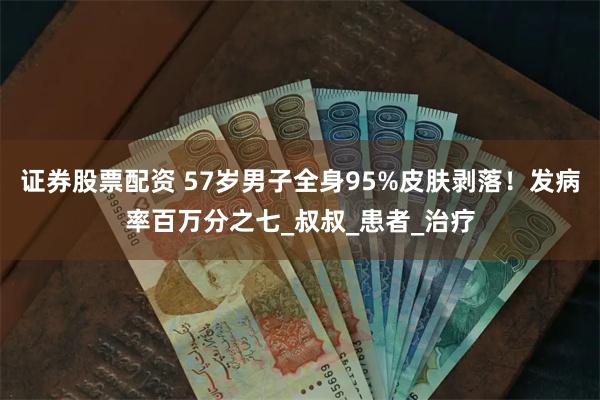 证券股票配资 57岁男子全身95%皮肤剥落！发病率百万分之七_叔叔_患者_治疗